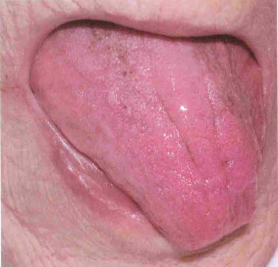 stroke sign deviated tongue