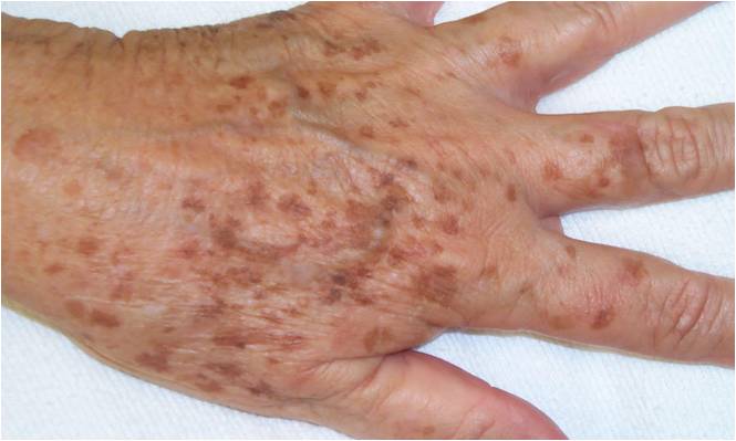 age spot
